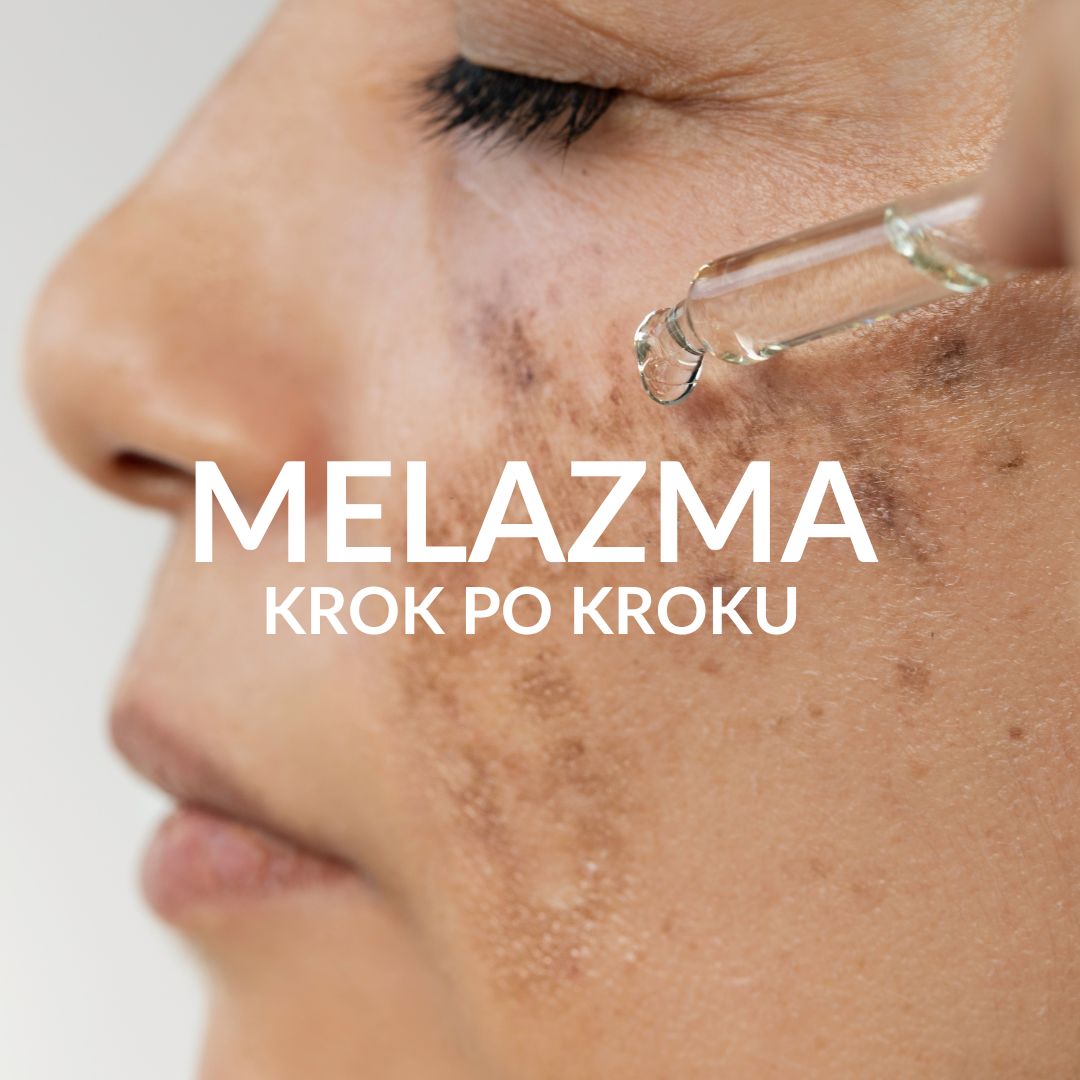 Melazma krok po kroku